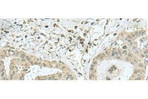 Immunohistochemistry of paraffin-embedded Human thyroid cancer tissue using THTPA Polyclonal Antibody at dilution of 1:70(x200) (THTPA antibody)