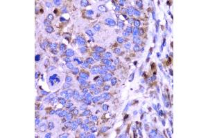 Immunohistochemistry of paraffin-embedded human esophageal cancer using SPARC antibody (ABIN5970787) at dilution of 1/100 (40x lens). (SPARC antibody)
