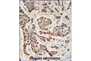 ATHL1 Antibody IHC analysis in formalin fixed and paraffin embedded human breast carcinoma followed by peroxidase conjugation of the secondary antibody and DAB staining. (ATHL1 antibody  (C-Term))