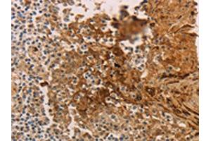 The image on the left is immunohistochemistry of paraffin-embedded Human tonsil tissue using ABIN7189672(ADCYAP1R1 Antibody) at dilution 1/70, on the right is treated with synthetic peptide. (ADCYAP1R1 antibody)