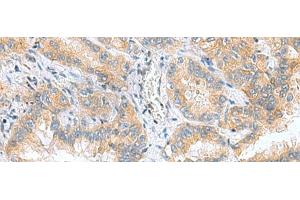 Immunohistochemistry of paraffin-embedded Human lung cancer tissue using RPS16 Polyclonal Antibody at dilution of 1:60(x200) (RPS16 antibody)