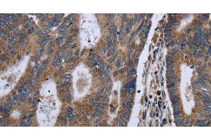 Immunohistochemistry of paraffin-embedded Human colon cancer using GSTA3 Polyclonal Antibody at dilution of 1:30 (GSTA3 antibody)