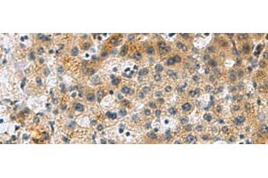 Immunohistochemistry of paraffin-embedded Human liver cancer tissue using PLIN4 Polyclonal Antibody at dilution of 1:50(x200) (PLIN4 antibody)