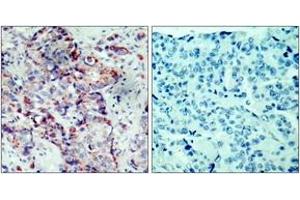 Immunohistochemistry analysis of paraffin-embedded human breast carcinoma, using SEK1/MKK4 (Phospho-Ser80) Antibody. (MAP2K4 antibody  (pSer80))