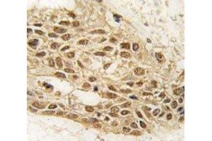 IHC analysis Dnmt3a antibody and human lung carcinoma tissue (DNMT3A antibody  (AA 31-61))