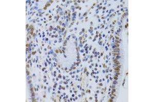 Immunohistochemistry of paraffin-embedded human gastric cancer using XRCC5 Antibody. (XRCC5 antibody  (AA 543-732))