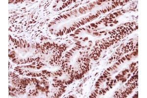 IHC-P Image Immunohistochemical analysis of paraffin-embedded human colon carcinoma, using SNRPD2, antibody at 1:250 dilution. (SNRPD2 antibody)