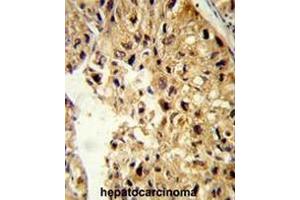 Formalin-fixed and paraffin-embedded human hepatocarcinoma reacted with PCBD1 Antibody (Center), which was peroxidase-conjugated to the secondary antibody, followed by DAB staining. (PCBD1 antibody  (Middle Region))