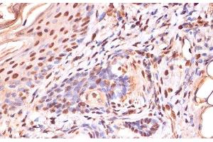 Immunohistochemistry of paraffin-embedded Human skin using Phospho-β-catenin(S33/S37/T41) Polyclonal Antibody at dilution of 1:100 (40x lens). (beta Catenin antibody  (pSer33, pSer37, pThr41))