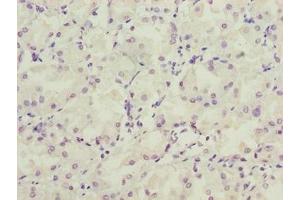 Immunohistochemistry of paraffin-embedded human gastric cancer using ABIN7158154 at dilution of 1:100
