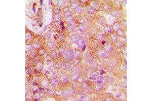 Immunohistochemical analysis of FAM84B staining in human breast cancer formalin fixed paraffin embedded tissue section. (FAM84B antibody  (N-Term))