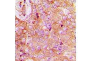 Immunohistochemical analysis of FAM84B staining in human breast cancer formalin fixed paraffin embedded tissue section. (FAM84B antibody  (N-Term))
