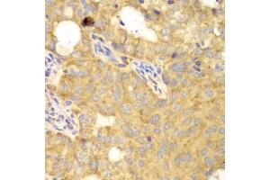 Immunohistochemistry of paraffin-embedded human oophoroma using GNB2L1 antibody. (GNB2L1 antibody)