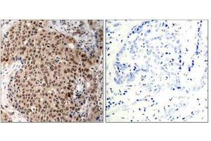 Immunohistochemical analysis of paraffin-embedded human breast carcinoma tissue using MAPKAPK-2(Phospho-Thr334) Antibody(left) or the same antibody preincubated with blocking peptide(right). (MAPKAP Kinase 2 antibody  (pThr334))
