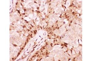 IHC-P: RUNX1 antibody testing of human breast cancer tissue