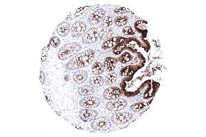 Moderate to strong CEA immunostaining in the epithelial cells of the colon. (Recombinant CEA antibody)