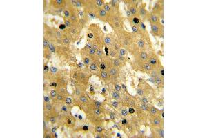 Formalin-fixed and paraffin-embedded human hepatocarcinoma reacted with SCP2 Antibody (Center), which was peroxidase-conjugated to the secondary antibody, followed by DAB staining. (SCP2 antibody  (AA 358-385))