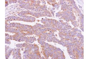 IHC-P Image alpha Dystroglycan antibody detects DAG1 protein at cytoplasm on human colon carcinoma by immunohistochemical analysis.