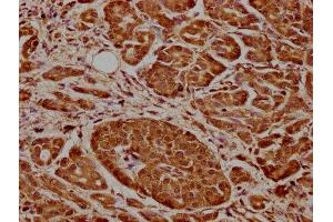 IHC image of ABIN7148861 diluted at 1:600 and staining in paraffin-embedded human pancreatic cancer performed on a Leica BondTM system. (CDK17 antibody  (AA 337-523))