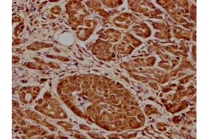 IHC image of ABIN7148861 diluted at 1:600 and staining in paraffin-embedded human pancreatic cancer performed on a Leica BondTM system.