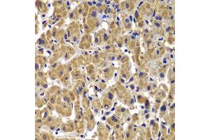 Immunohistochemistry of paraffin-embedded human liver cancer using MMP14 antibody. (MMP14 antibody)