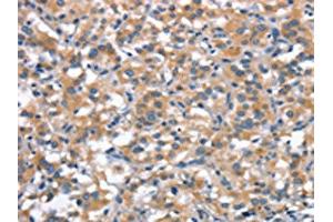 The image on the left is immunohistochemistry of paraffin-embedded Human thyroid cancer tissue using ABIN7189813(ANP32C Antibody) at dilution 1/30, on the right is treated with synthetic peptide. (ANP32C antibody)