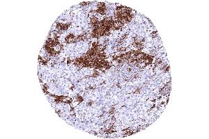 Testis HLA DRB1 negative seminoma showing HLA DRB1 staining of inflammatory cells and of small vessels HLA DRB1 immunohistochemistry (Recombinant HLA-DRB1 antibody)