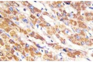 Immunohistochemistry (IHC) analyzes of Bax antibody in paraffin-embedded human liver carcinoma tissue. (LGALS7 antibody)