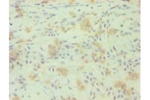 Immunohistochemistry of paraffin-embedded human breast cancer using ABIN7161881 at dilution of 1:100 (RORC antibody  (AA 1-518))