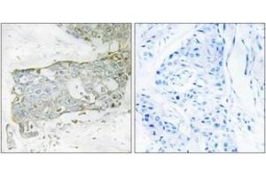 Immunohistochemistry analysis of paraffin-embedded human breast carcinoma tissue, using FA7 (light chain,Cleaved-Arg212) Antibody. (Factor VII antibody  (Cleaved-Arg212))