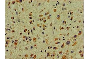 Immunohistochemistry of paraffin-embedded human glioma using ABIN7169039 at dilution of 1:100 (DCLK1 antibody  (AA 143-381))