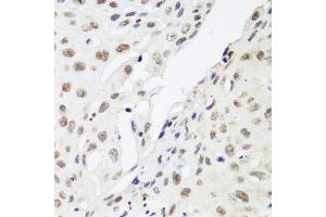 Immunohistochemistry of paraffin-embedded human lung cancer using CBX3 antibody at dilution of 1:200 (40x lens). (CBX3 antibody)