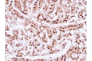 IHC-P Image Immunohistochemical analysis of paraffin-embedded human breast cancer, using ZNF323, antibody at 1:250 dilution.