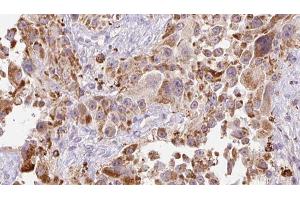 ABIN6273251 at 1/100 staining Human Melanoma tissue by IHC-P. (GREM2 antibody  (Internal Region))