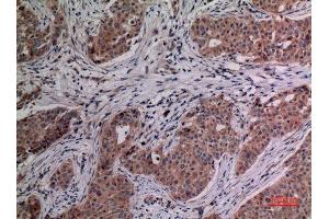 Immunohistochemistry (IHC) analysis of paraffin-embedded Human Breast Cancer, antibody was diluted at 1:100. (IL-4 antibody  (Internal Region))