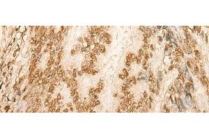 Immunohistochemistry of paraffin-embedded Human colorectal cancer tissue using HIST1H2BA Polyclonal Antibody at dilution of 1:45(x200)