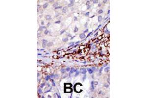 Formalin-fixed and paraffin-embedded human cancer tissue reacted with RNF216 polyclonal antibody  , which was peroxidase-conjugated to the secondary antibody, followed by DAB staining. (RNF216 antibody  (C-Term))