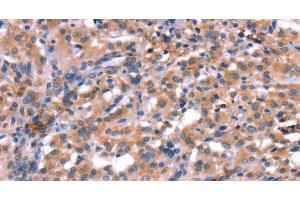 Immunohistochemistry of paraffin-embedded Human thyroid cancer using HMGCS1 Polyclonal Antibody at dilution of 1:40 (HMGCS1 antibody)