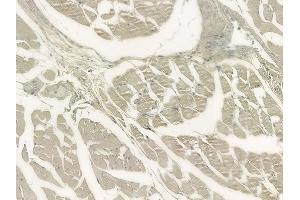 ABIN6264555 and ABIN6273303 at 1/100 staining human lung adenocarcinoma by IHC-P. (RAB12 antibody  (C-Term))