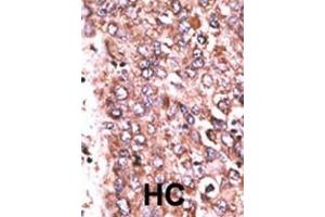 Formalin-fixed and paraffin-embedded human cancer tissue reacted with the primary antibody, which was peroxidase-conjugated to the secondary antibody, followed by DAB staining. (WISP3 antibody  (AA 305-335))