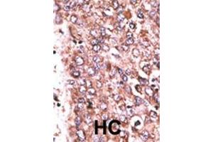 Formalin-fixed and paraffin-embedded human cancer tissue reacted with the primary antibody, which was peroxidase-conjugated to the secondary antibody, followed by DAB staining. (WISP3 antibody  (AA 305-335))