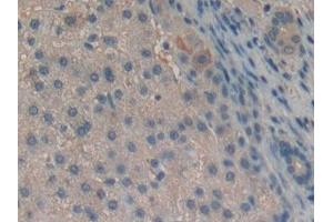 Detection of Slit2 in Human Liver cancer Tissue using Polyclonal Antibody to Slit Homolog 2 (Slit2) (SLIT2 antibody  (AA 1416-1528))