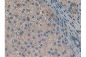 Detection of Slit2 in Human Liver cancer Tissue using Polyclonal Antibody to Slit Homolog 2 (Slit2)