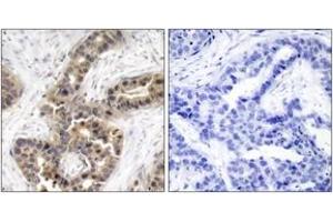 Immunohistochemistry analysis of paraffin-embedded human breast carcinoma, using G3BP-1 (Phospho-Ser232) Antibody. (G3BP1 antibody  (pSer232))