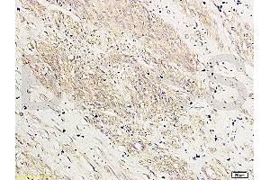 Formalin-fixed and paraffin-embedded: human breast cancer labeled with Rabbit Anti-HOXA10 Polyclonal Antibody (ABIN741195) , Unconjugated 1:200 followed by conjugation to the secondary antibody and DAB staining (HOXA10 antibody  (AA 311-410))