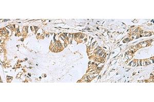 Immunohistochemistry of paraffin-embedded Human gastric cancer tissue using TUBD1 Polyclonal Antibody at dilution of 1:70(x200)