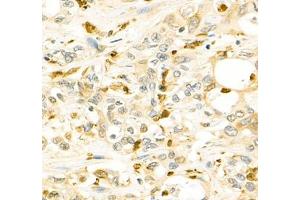 Immunohistochemistry of paraffin embedded human Cholangiocarcinoma using ANXA3 (ABIN7073065) at dilution of 1: 200 (400x lens) (Annexin A3 antibody)