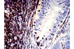 Immunohistochemical analysis of paraffin-embedded rectum cancer tissues using CD11a mouse mAb with DAB staining. (ITGAL antibody  (AA 26-194))