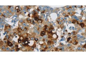 Immunohistochemistry of paraffin-embedded Human breast cancer using LCN2 Polyclonal Antibody at dilution of 1:60 (Lipocalin 2 antibody)