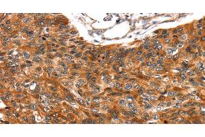 Immunohistochemistry of paraffin-embedded Human esophagus cancer tissue using TRIM69 Polyclonal Antibody at dilution 1:40 (TRIM69 antibody)